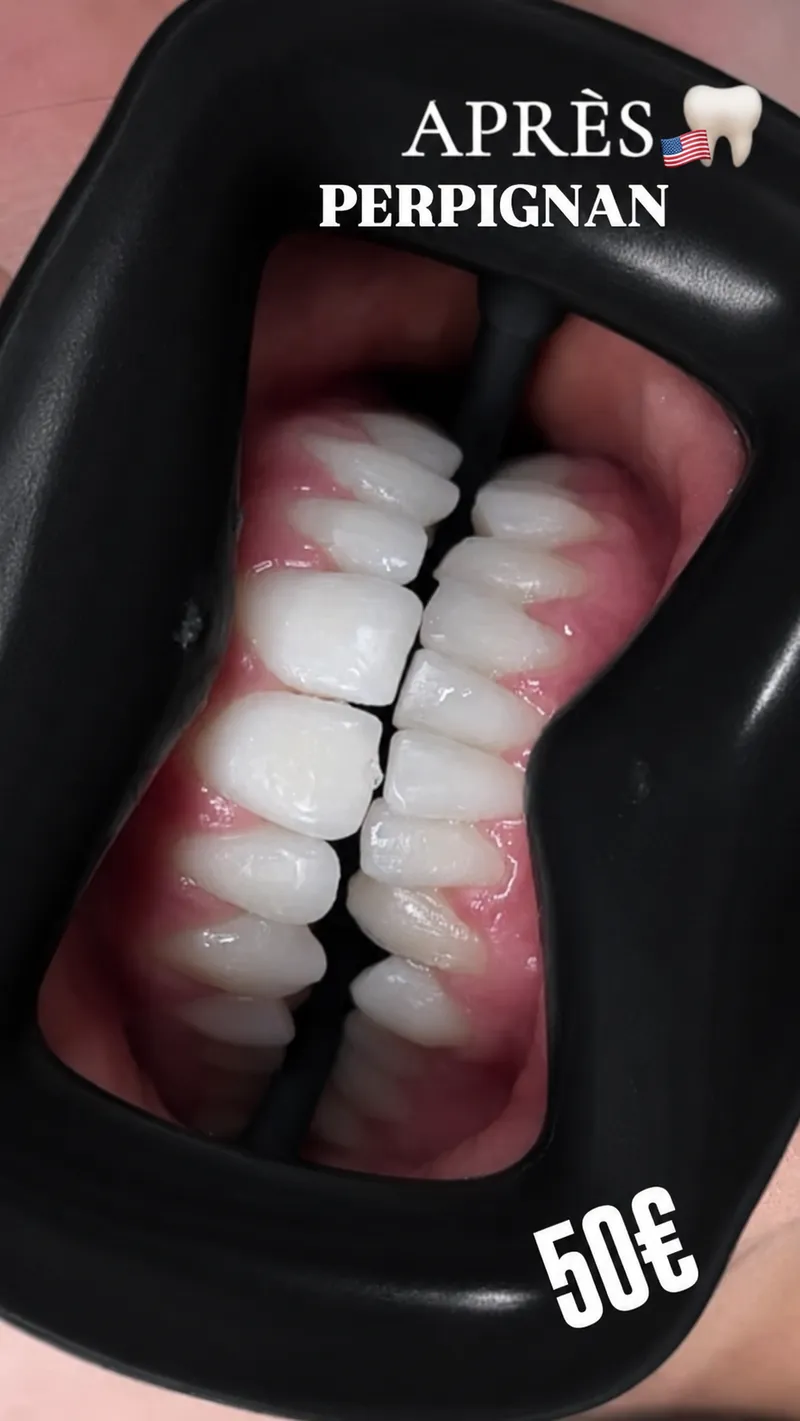BLANCHIMENT DENTAIRE 1 SÉANCE 🦷 - Détail 2