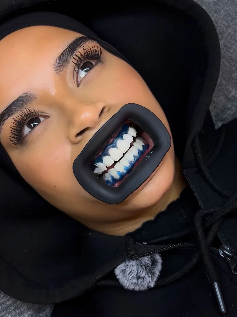BLANCHIMENT DENTAIRE FORFAIT 2 SÉANCE 🦷 - Détail 2